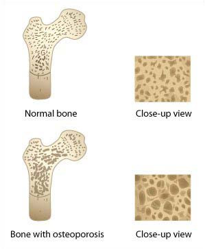 osteoporosis Images and Graphics