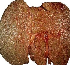 liver disease Images and Graphics