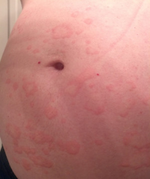 Rash From Laundry Detergent