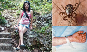 ... woman's limbs amputated after contracting Rocky Mountain spotted fever