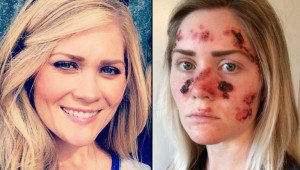 ... diagnosed with skin cancer at 21, wants you to stop using tanning beds