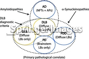 ... dementia (PDD). AD, Alzheimer’s disease; AP, amyloid plaque; LB
