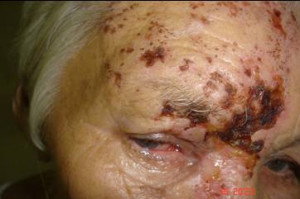 Ophthalmic Herpes Zoster