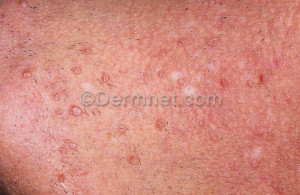 Warts Digitate Photo