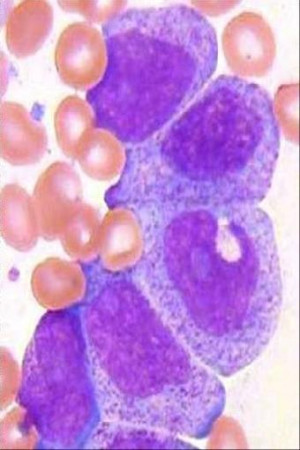 leukemia Images and Graphics