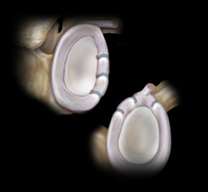 Knotless Labral, Instability, ALPSA and HAGL Lesion Repair
