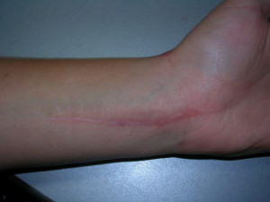 Cutting Wrist Scars Cut wrist scar