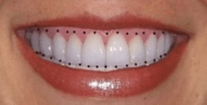 Smiles Teeth Cosmetic-smile-design-5. tooth
