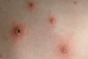 With Varicella Chickenpox...