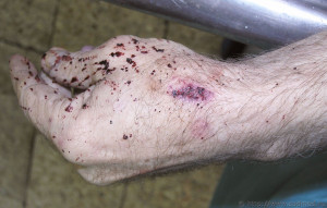 Hand and forearm crushed in printing press machine * Guy trapped under ...