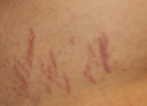Displaying 18> Images For Cushings Syndrome Stretch Marks picture