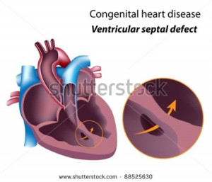 Congenital Heart Disease...