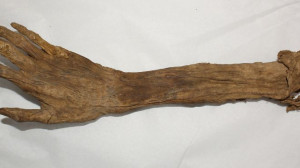 ... by the National Museum of Civil War Medicine shows a human arm. AP