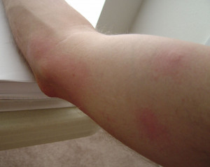 Related Pictures bee stings funny falling out of my chair with ...