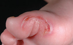 month-old boy are concerned about recurring eruptions of blisters