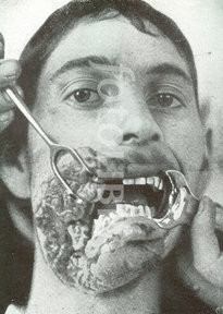 Horror of war: Facial injuries to German soldier in World War I.