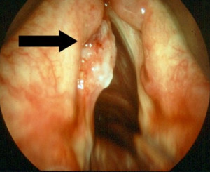 Throat Cancer Look Like