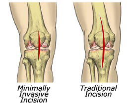 ... Knee Replacement, During, After, Procedure, Surgery, Recovery Time