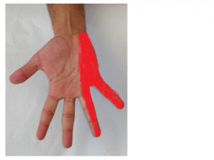 Acupuncture and Wrist Pain After Bike Riding-Ulnar Nerve Impingement ...