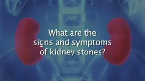 Kidney Stones Symptoms and Treatment | PopScreen