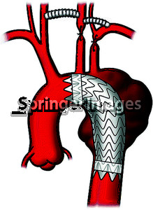 And Left Carotid Subclavian Bypass