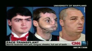 Mar 21 2011 Dallas Wiens Receives The Nations First Ever Full Face