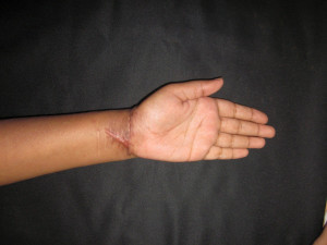 ... -young-female-cut-both-her-wrists-wrist-20cutter-20-284-29.jpg