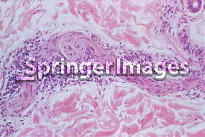 Dermal histopathology in indeterminate leprosy