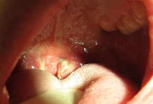 Varicella+zoster+virus+igg