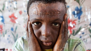 This Darfur boy was wounded when his brother set off some unexploded ...