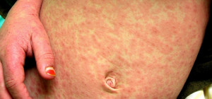 Measles Cases Triple In 2013