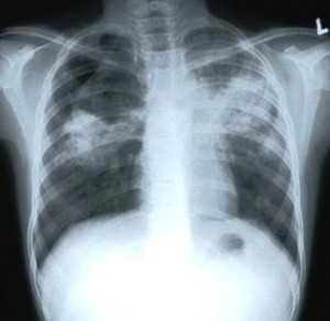 TB diagnosis: X-ray scans unavailable ‘until release of funds’