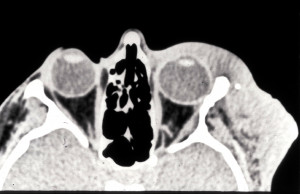 Neurofibromatosis Images