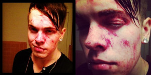 Set It Off’s Cody Carson injured at last night’s show