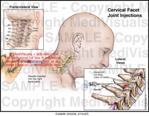 Facet Injections in Neck