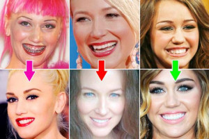 Celebs Transformed by Braces! (10 before and Afters)