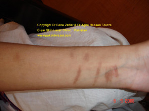 Showing Gallery For Scars From Cutting Wrist