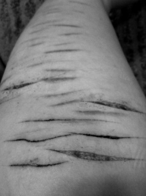 suicide lonely alone self harm cut cutter cutting cuts Scar scars ...