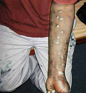 Auf einen intravenösen Heroinkonsum deuten Einstichstellen (nicht nur ...