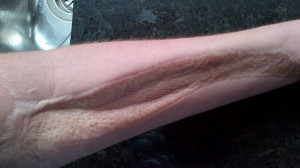 Bummer. I had compartment syndrome in my arm and this is how MY scar ...