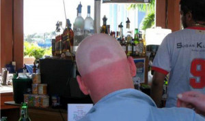 Summer tan lines that went wrong. (15)
