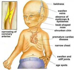 The symptoms of progeria include:
