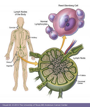 Hodgkins Lymphoma Knowledge...