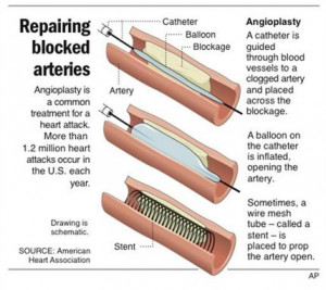 Graphic shows how an angioplasty procedure is performed