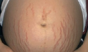 Stretch Marks White Removal