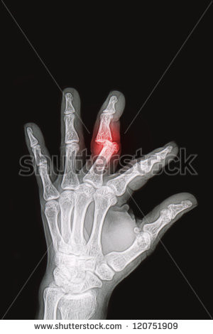 Broken Wrist X Ray Right Hand Wrist and hand x-rays image