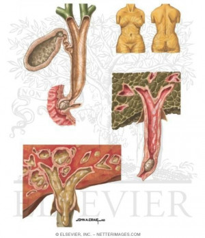 Common Bile Duct Obstruction