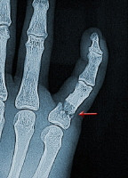 Broken Ring Finger X Ray Broken finger. this x-ray