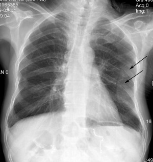 Broken Ribs X rays