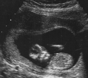 ultrasound at 13 weeks pregnant